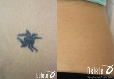 Tattoo Removal before and after photo