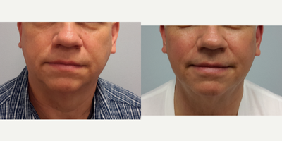 Ultherapy before and after photo