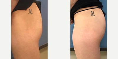 Bellafill before and after photo
