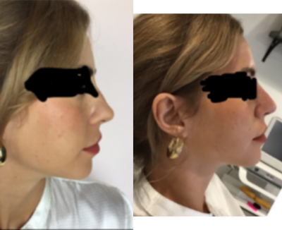 Dermal Fillers before and after photo