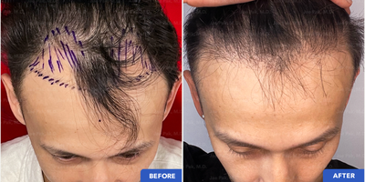 Forehead Reduction before and after photo