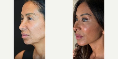Eyelid Surgery before and after photo