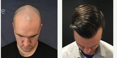 FUE Hair Transplant before and after photo