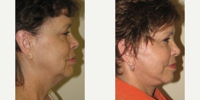 Neck Lift before and after photo