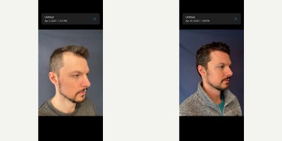 NeoGraft before and after photo