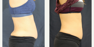 SculpSure before and after photo