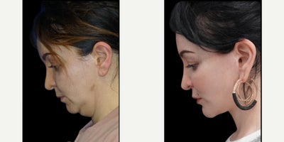 Chin Implant before and after photo