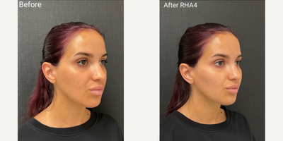 Dermal Fillers before and after photo