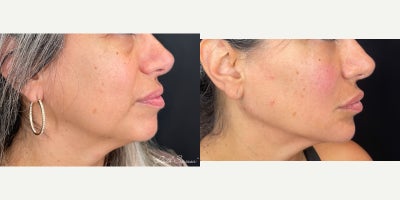 Dermal Fillers before and after photo