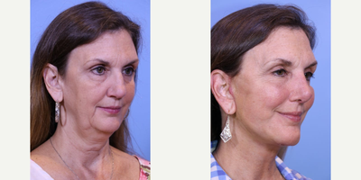 Facelift before and after photo