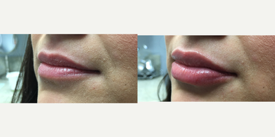 Lip Fillers before and after photo
