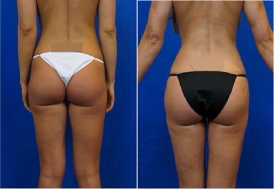Liposuction before and after photo