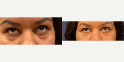 Restylane before and after photo