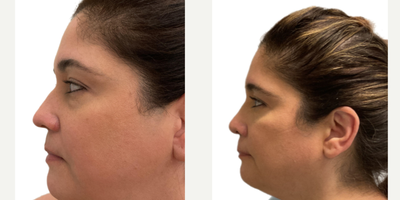 Rhinoplasty before and after photo