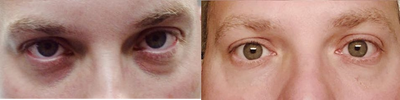Voluma before and after photo