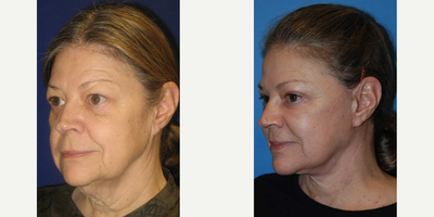 Eyelid Surgery before and after photo