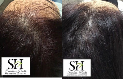 PRP Injections before and after photo