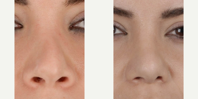 Revision Rhinoplasty before and after photo
