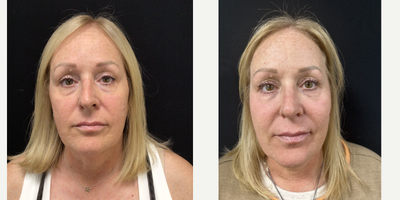 Rhinoplasty before and after photo