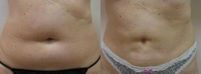 Smart Lipo before and after photo