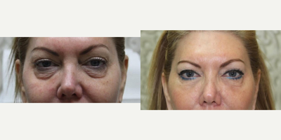 Dermal Fillers before and after photo