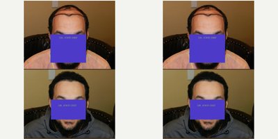 Hair Transplant before and after photo