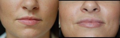 Juvederm before and after photo