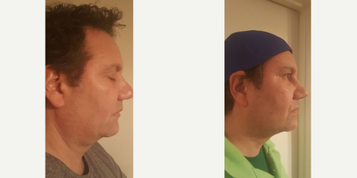 Kybella before and after photo