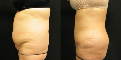 Tummy Tuck before and after photo