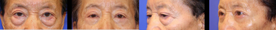 Eyelid Surgery before and after photo