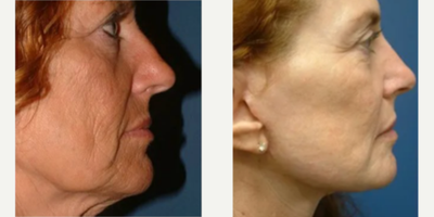Mini Facelift before and after photo