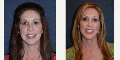 Porcelain Veneers before and after photo