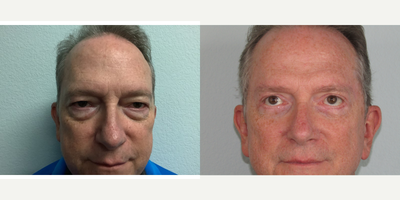 Eyelid Surgery before and after photo