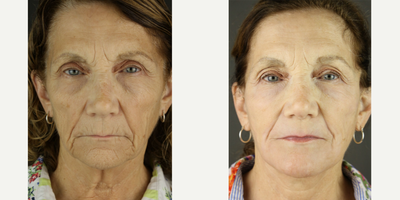 Facelift before and after photo