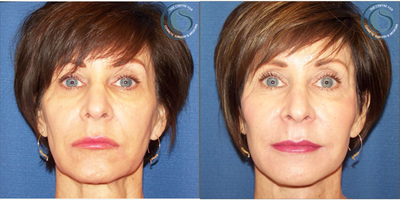 Facial Fat Transfer before and after photo
