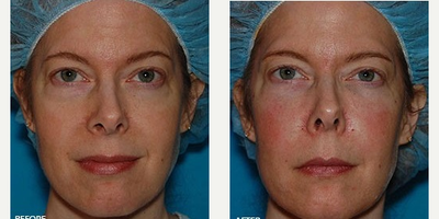 Facial before and after photo