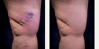Sclerotherapy before and after photo