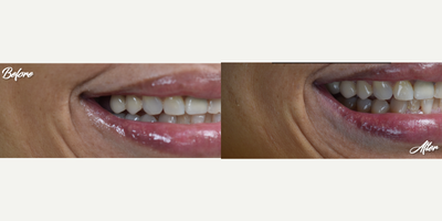 Dental Crown before and after photo