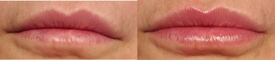 Dermal Fillers before and after photo