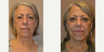 Eyelid Surgery before and after photo