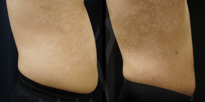 Smart Lipo before and after photo