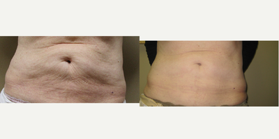 Vanquish before and after photo