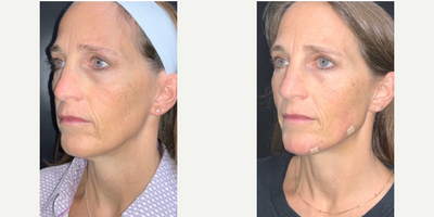 Dermal Fillers before and after photo