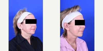 Neck Lift before and after photo