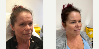 Nonsurgical Facelift before and after photo