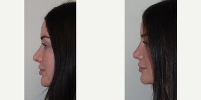 Revision Rhinoplasty before and after photo