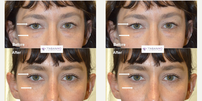 Eyelid Surgery before and after photo