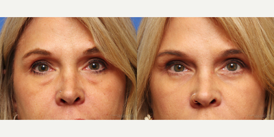 Eyelid Surgery before and after photo
