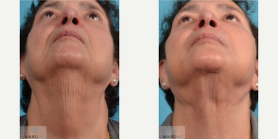 Facial Fat Transfer before and after photo
