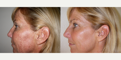 IPL before and after photo